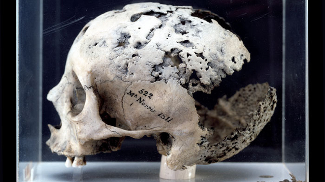 Human Skull in the Hunterian Museum